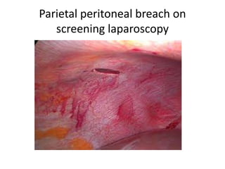 Parietal peritoneal breach on
screening laparoscopy
 