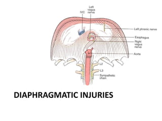 DIAPHRAGMATIC INJURIES
 