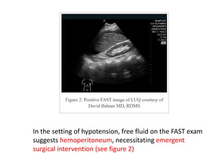 In the setting of hypotension, free fluid on the FAST exam
suggests hemoperitoneum, necessitating emergent
surgical intervention (see figure 2)
 