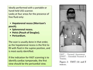 Ideally performed with a portable or
hand-held USS scanner.
Looks at four areas for the presence of
free ﬂuid only:
• Hepatorenal recess (Morrison’s
pouch).
• Splenorenal recess.
• Pelvis (Pouch of Douglas).
• Pericardium.
The scan is usually done in that order,
as the hepatorenal recess is the ﬁrst to
ﬁll with ﬂuid in the supine position, and
is most easily identiﬁed.
If the indication for FAST scanning is to
identify cardiac tamponade, the ﬁrst
view should be the pericardial view.
 
