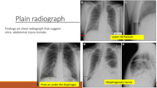 Plain radiograph
Findings on chest radiograph that suggest
intra- abdominal injury include:
Lower rib fracture
•Diaphragmatic hernia
•Free air under the diaphragm
 