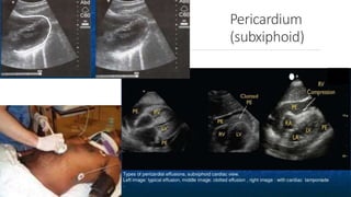 Pericardium
(subxiphoid)
 