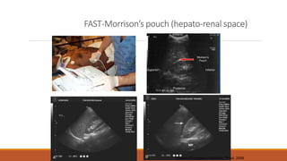 FAST-Morrison’s pouch (hepato-renal space)
Rosen’s Emergency Medicine, 7th ed. 2009
 