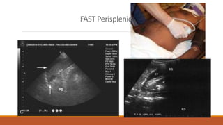 FAST Perisplenic view
 