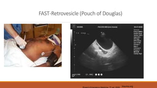 FAST-Retrovesicle (Pouch of Douglas)
trauma.org
th
 