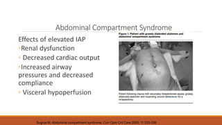 Abdominal Compartment Syndrome
Effects of elevated IAP
◦Renal dysfunction
◦ Decreased cardiac output
◦Increased airway
pressures and decreased
compliance
◦ Visceral hypoperfusion
Sugrue M. Abdominal compartment syndrome. Curr Opin Crit Care 2005; 11:333-338
 