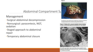 Abdominal Compartment Syndrome
Management
◦Surgical abdominal decompression
◦Nonsurgical: paracentesis, NGT,
sedation
◦Staged approach to abdominal
repair
◦Temporary abdominal closure
 