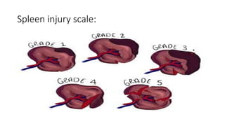 Splenic Injury Classification Abdominal trauma is most commonly occur in children.pptx