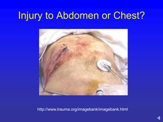 Comprehensive Management of Abdominal Trauma in Emergency Medicine | PDF