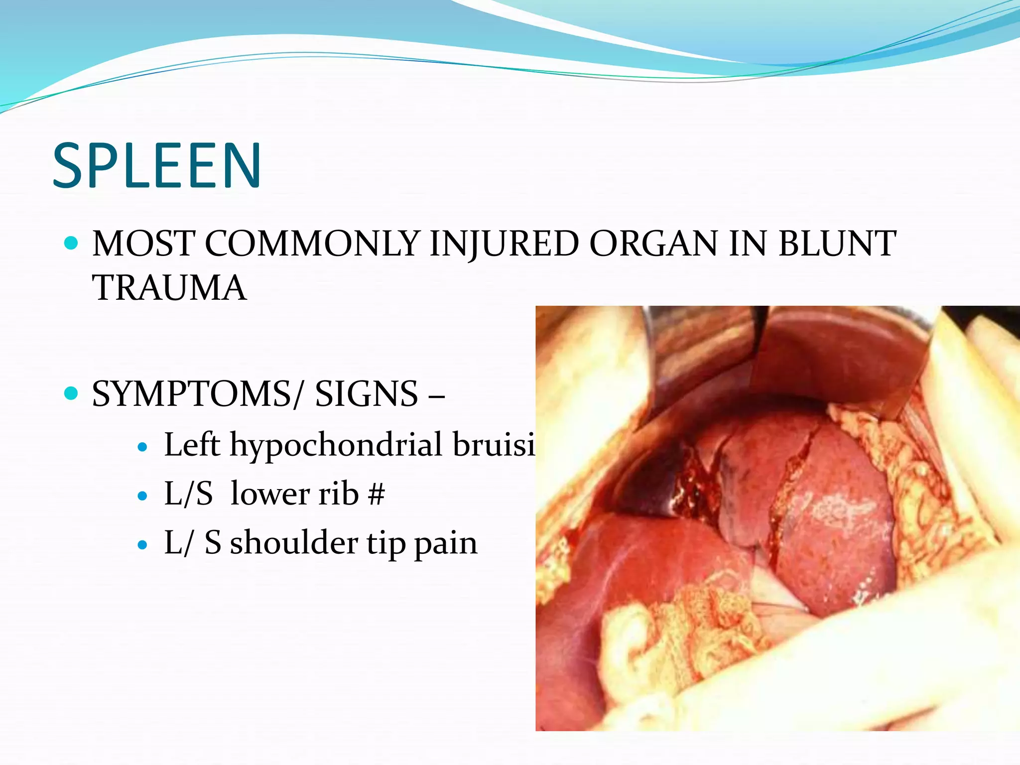 SPLEEN
 MOST COMMONLY INJURED ORGAN IN BLUNT
TRAUMA
 SYMPTOMS/ SIGNS –
 Left hypochondrial bruisig
 L/S lower rib #
 L/ S shoulder tip pain
 
