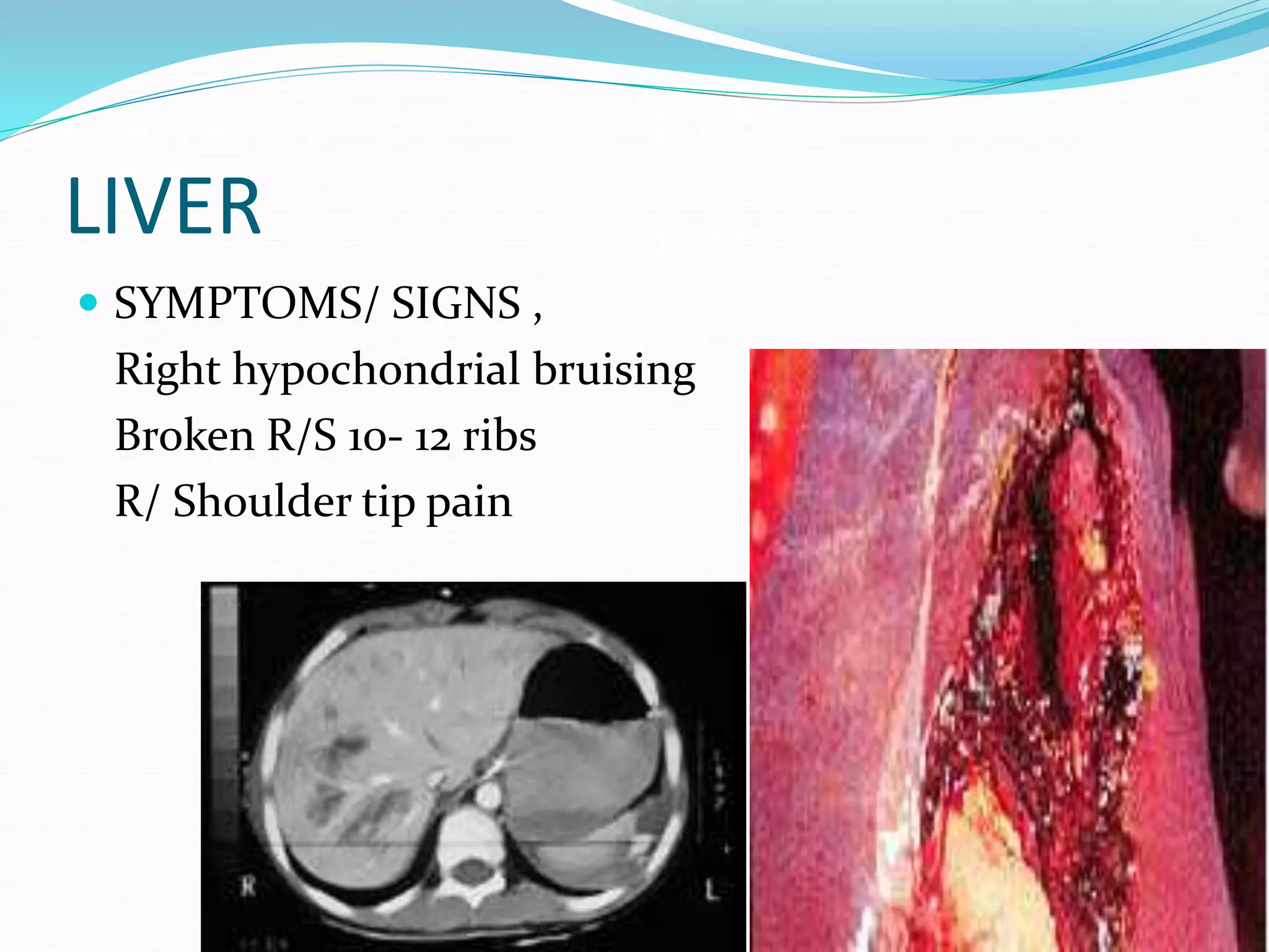 LIVER
 SYMPTOMS/ SIGNS ,
Right hypochondrial bruising
Broken R/S 10- 12 ribs
R/ Shoulder tip pain
 