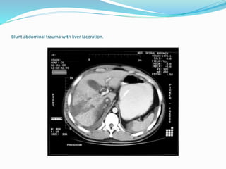 Blunt abdominal trauma with liver laceration.
 