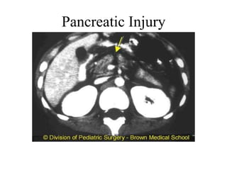 Pancreatic Injury
 