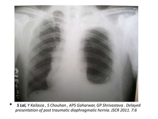 Diaphragm Rupture /Hernia




•    S Lal, Y Kailasia , S Chouhan , APS Gaharwar, GP Shrivastava . Delayed
    presentation of post traumatic diaphragmatic hernia. JSCR 2011. 7:6
 