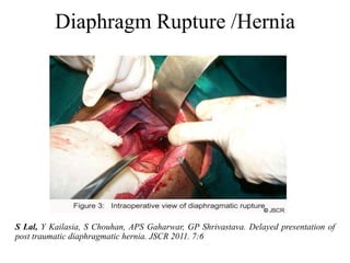 Diaphragm Rupture /Hernia




S Lal, Y Kailasia, S Chouhan, APS Gaharwar, GP Shrivastava. Delayed presentation of
post traumatic diaphragmatic hernia. JSCR 2011. 7:6
 