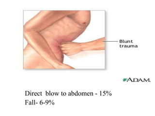 Direct blow to abdomen - 15%
Fall- 6-9%
 