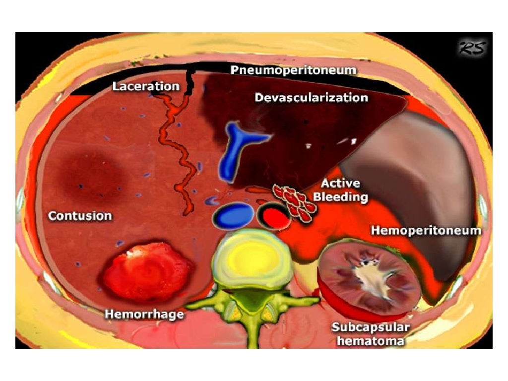 Abdominal trauma an overview