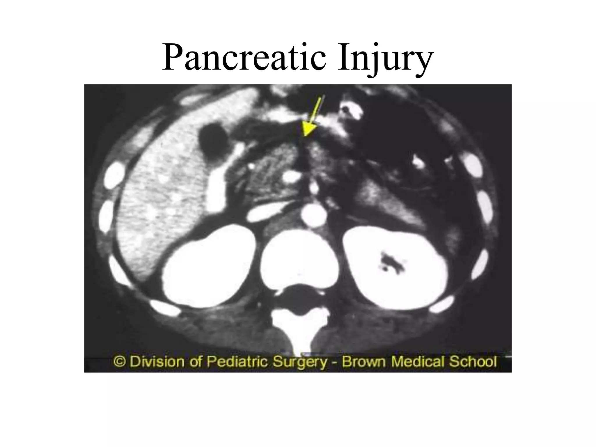 Pancreatic Injury
 