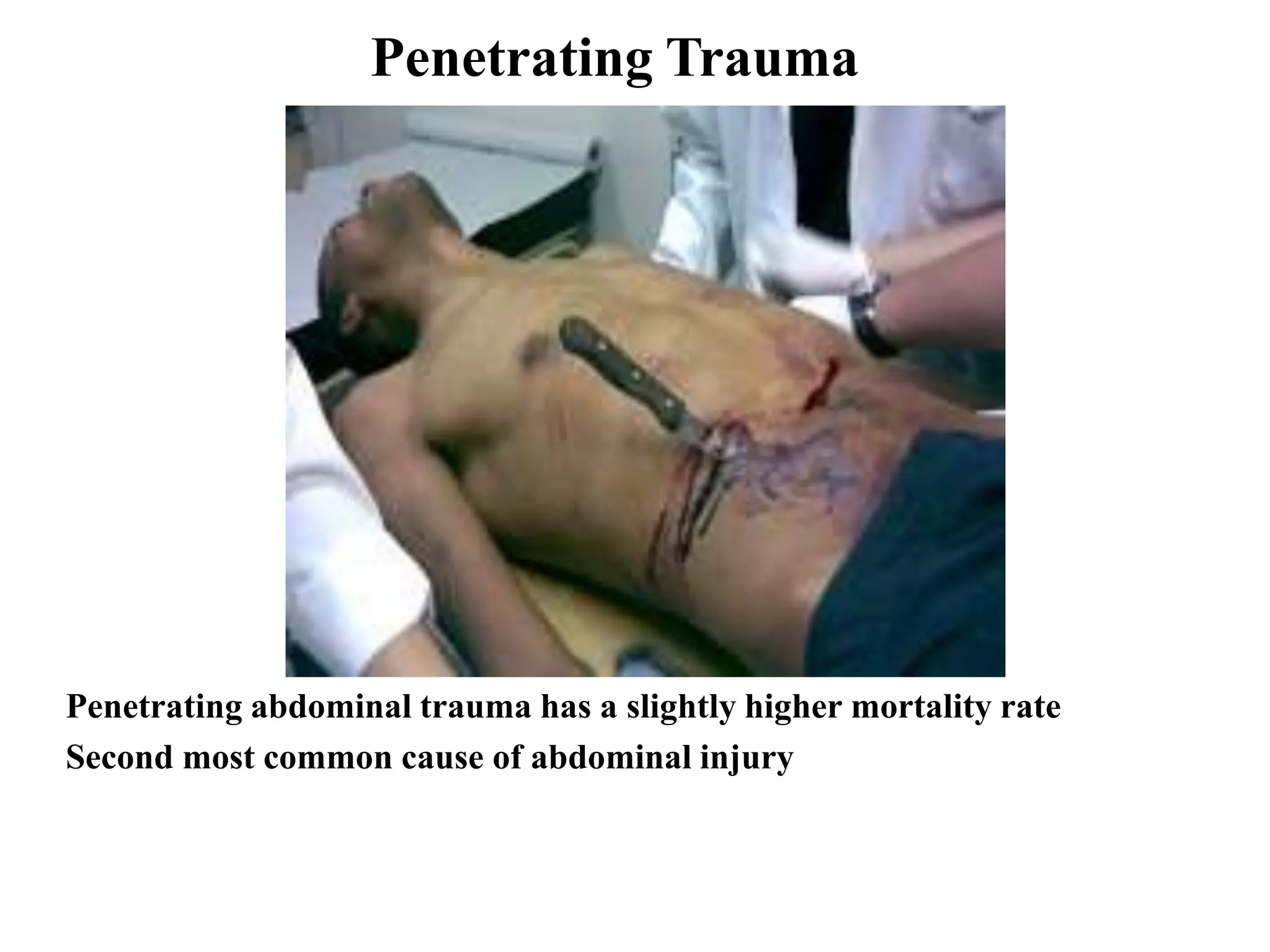 Penetrating Trauma
Penetrating abdominal trauma has a slightly higher mortality rate
Second most common cause of abdominal injury
 