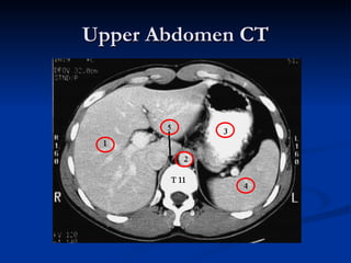 Upper Abdomen CT 