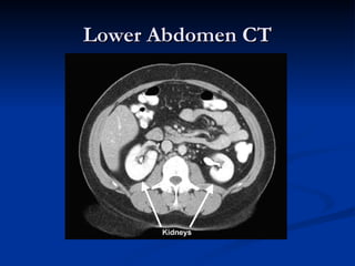 Lower Abdomen CT 