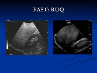 FAST: RUQ 