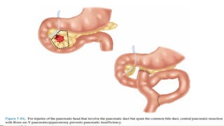 abdominal trauma powerpoint.pptx........ | PPTX