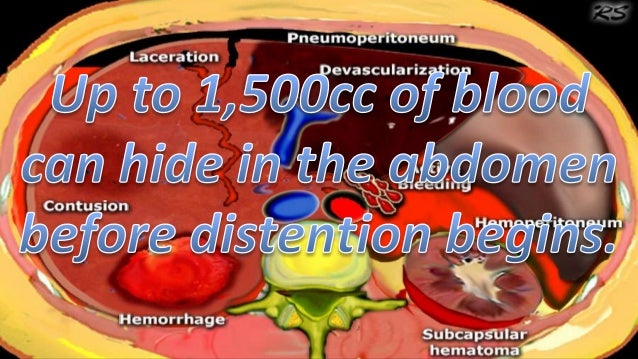 Abominable Abdominal Trauma SlideShare Version
