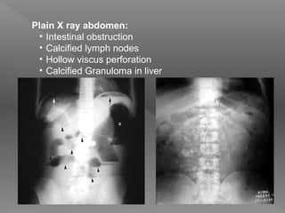 Plain X ray abdomen:
• Intestinal obstruction
• Calcified lymph nodes
• Hollow viscus perforation
• Calcified Granuloma in liver
 
