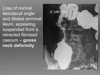 Loss of normal
ileocaecal angle
and dilated terminal
ileum, appearing
suspended from a
retracted fibrosed
caecum – goose
neck deformity
 