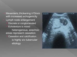 • Mesenteric thickening ≥15mm
with increased echogenicity
• Lymph node enlargement
Discrete or conglomerated
Echotexture is mixed
heterogenous, anechoic
areas represent caseation
Caseation and calcification
is highly s/o tubercular
etiology
 