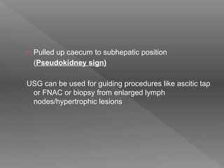 • Pulled up caecum to subhepatic position
(Pseudokidney sign)
USG can be used for guiding procedures like ascitic tap
or FNAC or biopsy from enlarged lymph
nodes/hypertrophic lesions
 