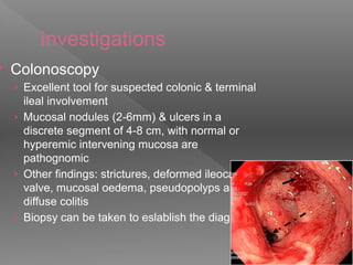 Investigations
 Colonoscopy
› Excellent tool for suspected colonic & terminal
ileal involvement
› Mucosal nodules (2-6mm) & ulcers in a
discrete segment of 4-8 cm, with normal or
hyperemic intervening mucosa are
pathognomic
› Other findings: strictures, deformed ileocaecal
valve, mucosal oedema, pseudopolyps and
diffuse colitis
› Biopsy can be taken to eslablish the diagnosis
 