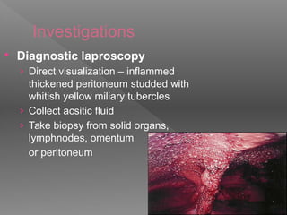 Investigations
 Diagnostic laproscopy
› Direct visualization – inflammed
thickened peritoneum studded with
whitish yellow miliary tubercles
› Collect acsitic fluid
› Take biopsy from solid organs,
lymphnodes, omentum
or peritoneum
 