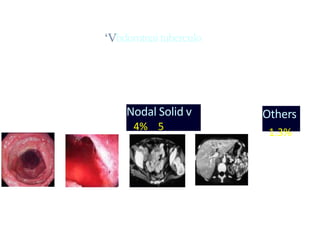 ‘Vbdomtnaituberculo
Nodal Solid v
4% 5
Others
1.3%
 