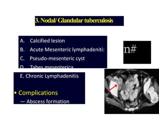 3.Nodal/Glandulartuberculosis
A. Calcified lesion
B. Acute Mesenteric lymphadeniti:
C. Pseudo-mesenteric cyst
D. Tabes mesenterica
n#
E. Chronic Lymphadenitis
• Complications
— Abscess formation
 