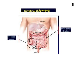 1
1.Intestinal tUberculosis
Small bowel
& colon
Ileocaecal
region
 