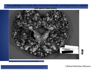 Gross pathology of resected spleen showing innumerable caseating granulomas consistent
with splenic tuberculosis.
Mackowiak P A et al. Clin Infect Dis. 2011;52:418-420
Clinical Infectious Diseases
The Author 2011. Published by Oxford University Press on behalf of the Infectious Diseases Society of
America. All rights reserved. For Permissions, please e-mail: journals.permissions@oup.com.
 