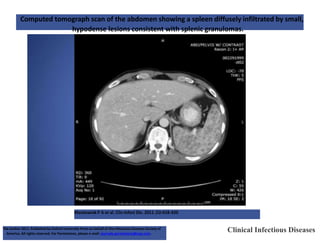 Computed tomograph scan of the abdomen showing a spleen diffusely infiltrated by small,
hypodense lesions consistent with splenic granulomas.
Mackowiak P A et al. Clin Infect Dis. 2011 ;52:418-420
Clinical Infectious Diseases
The Author 2011. Published by Oxford University Press on behalf of the Infectious Diseases Society of
America. All rights reserved. For Permissions, please e-mail: journals.permissions@oup.com.
 