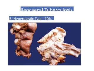 Ileocaecal Tuberculosis
B. Hyperplastic Type -10%
 