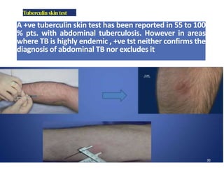 Tuberculinskintest
A +ve tuberculin skin test has been reported in 55 to 100
% pts. with abdominal tuberculosis. However in areas
where TB is highly endemic , +ve tst neither confirms the
diagnosis of abdominal TB nor excludes it
 