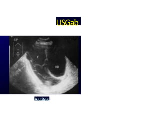 USGab
Ascites
 