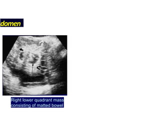 domen
Right lower quadrant mass
consisting of matted bowel
 