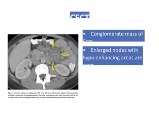 CECT
• Conglomerate mass of
6cm.
• Enlarged nodes with
hypo enhancing areas are
seen.
Fig. 1: Contrast enhanced abdominal CT of a 21 year-old female patient demonstrates
multiple mesenteric lymphadenopathy forming a conglomerate mass (arrows) with 6 cm
in major axis. Most enlarged nodes have central hypoenhancing areas due to necrosis.
 