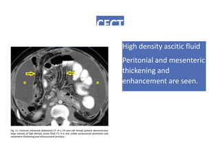 CECT
High density ascitic fluid
Peritonial and mesenteric
thickening and
enhancement are seen.
Fig. 11: Contrast enhanced abdominal CT of a 19 year-old female patient demonstrates
large volume of high density ascitic fluid (*). It is also visible pronounced peritoneal and
mesenteric thickening and enhancement (arrows).
 