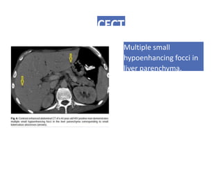CECT
Multiple small
hypoenhancing focci in
liver parenchyma.
 