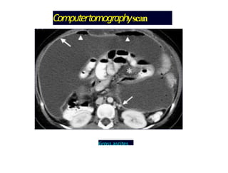 Computertomographyscan
Gross ascites
 