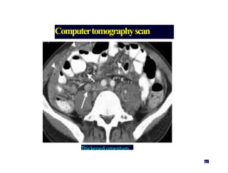 Computertomographyscan
Thickened omentum
45
 