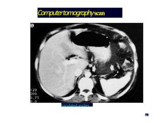 Computertomographyscan
Loculated ascites
46
 