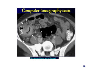 Thickened ileocaecal bowel
47
 